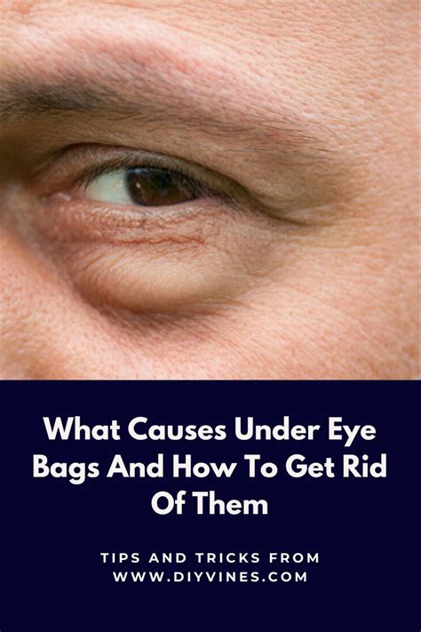 what causes bags under eyes.